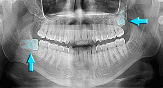 Wisdom Teeth Extraction - from Willow Dental Care