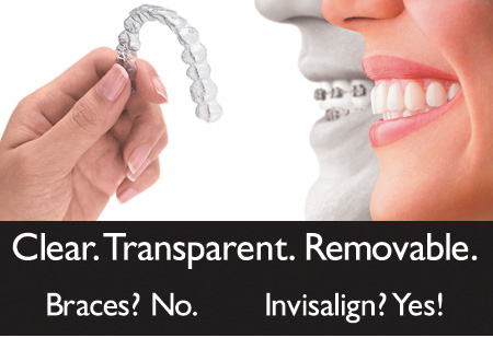 invisalign_tri