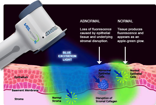 velscope-vx-how-it-works